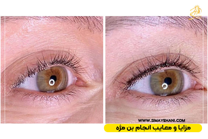 انجام بن مژه براساس مزایا و معایب