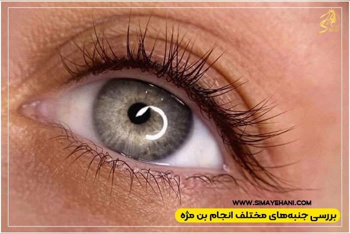  انجام بن مژه 