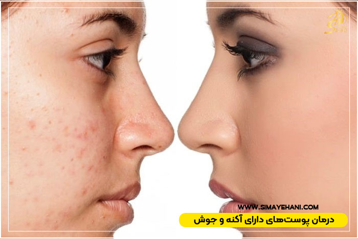 تاثیر پاکسازی پوست بر جوش و آکنه