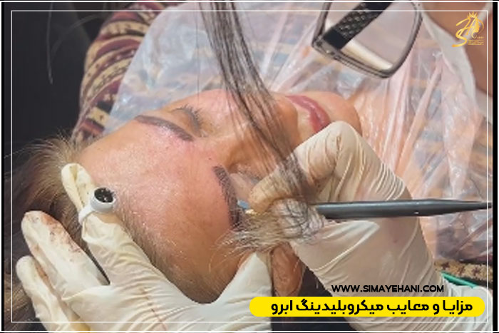 معایب میکروبلیدینگ