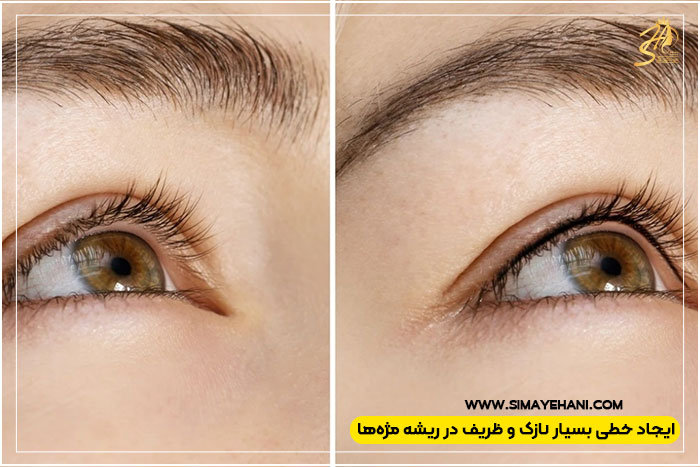 بن مژه چشم چیست؟ 