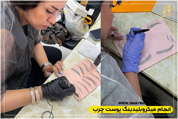 میکروبلیدینگ پوست چرب