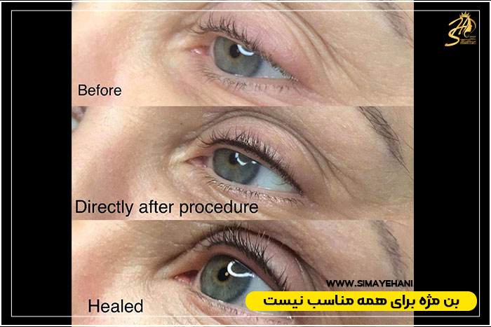 پیشگیری از عوارض بن مژه