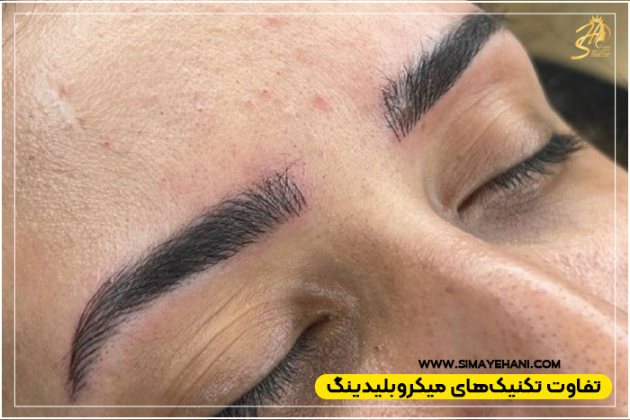 میکروبلیدینگ