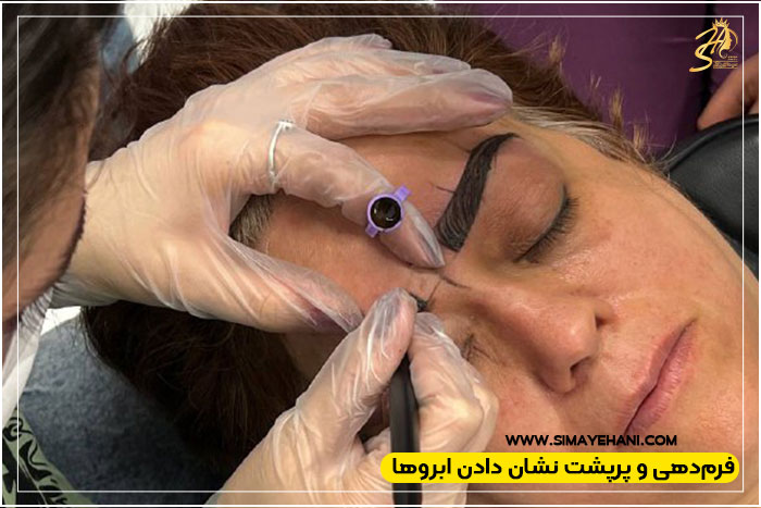 میکروبلیدینگ پوست چرب
