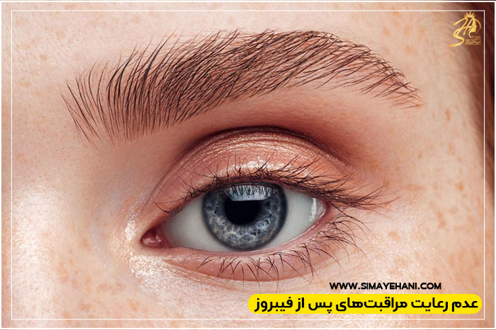 ماندگاری فیبروز ابرو