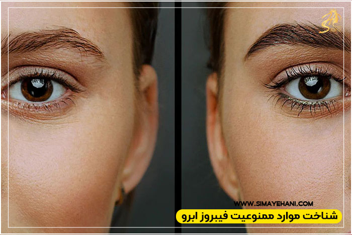 بیماری‌های پوستی و پزشکی ممنوعه برای فیبروز ابرو
