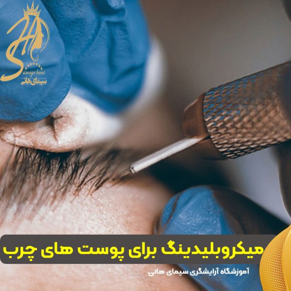 اجرای میکروبلیدینگ