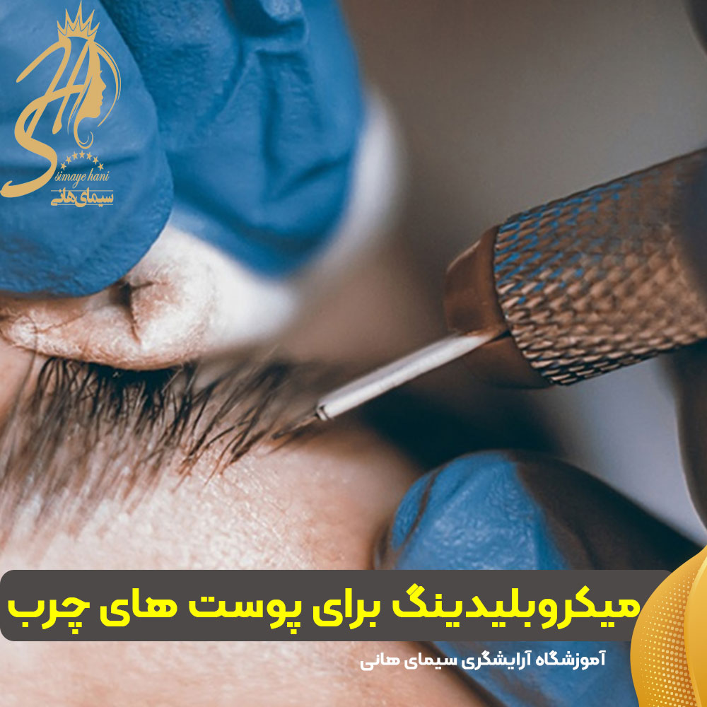 اجرای میکروبلیدینگ