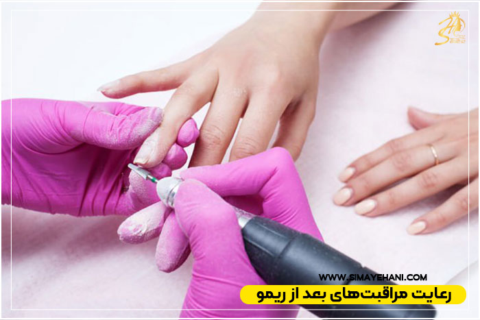 مراقبت‌های ضروری پس از ریمو کاشت ناخن