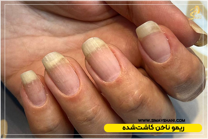 خطرات ریمو خانگی کاشت ناخن