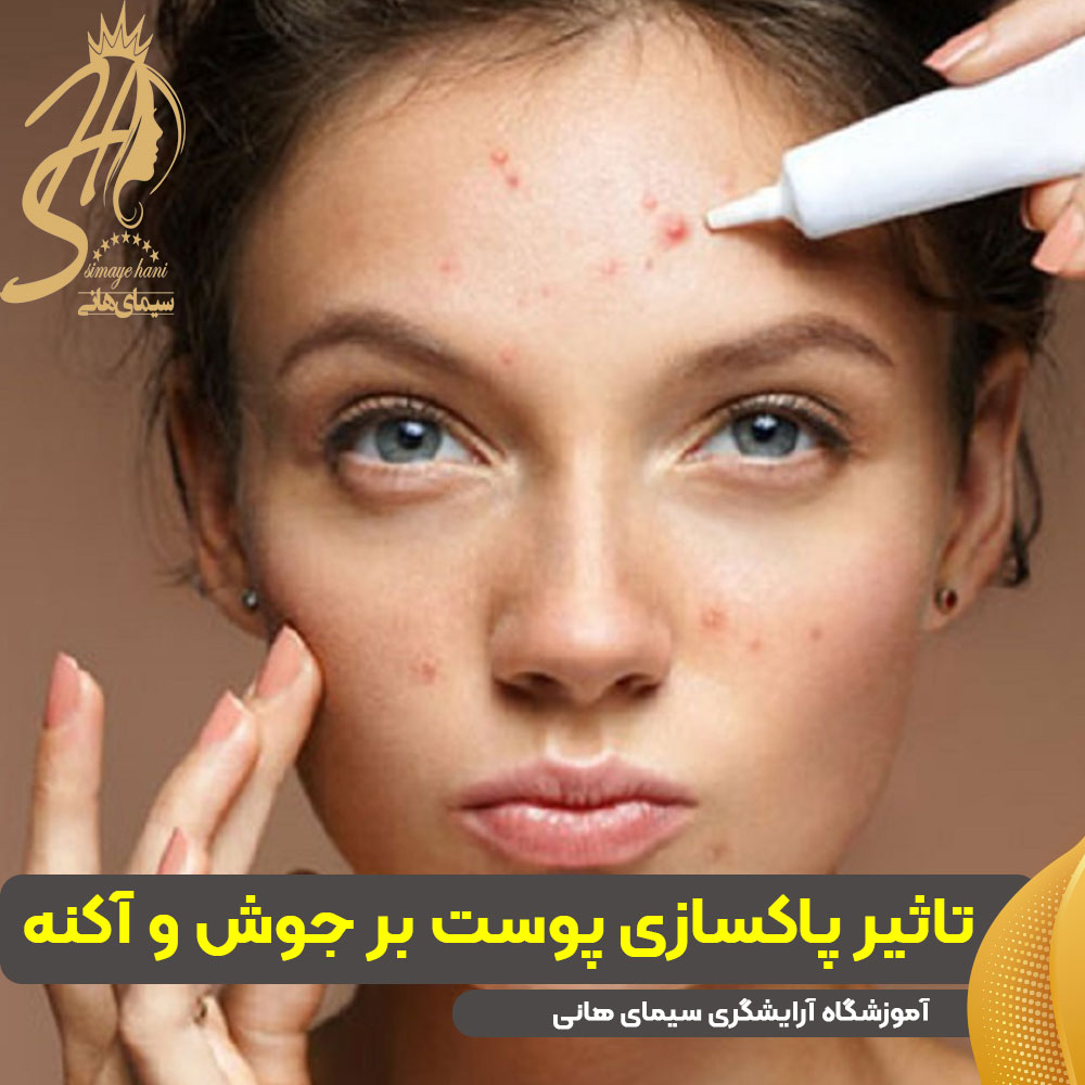 تاثیر پاکسازی پوست بر جوش و آکنه