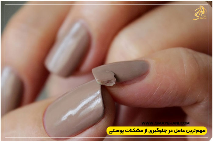 کاهش عوارض کاشت ناخن