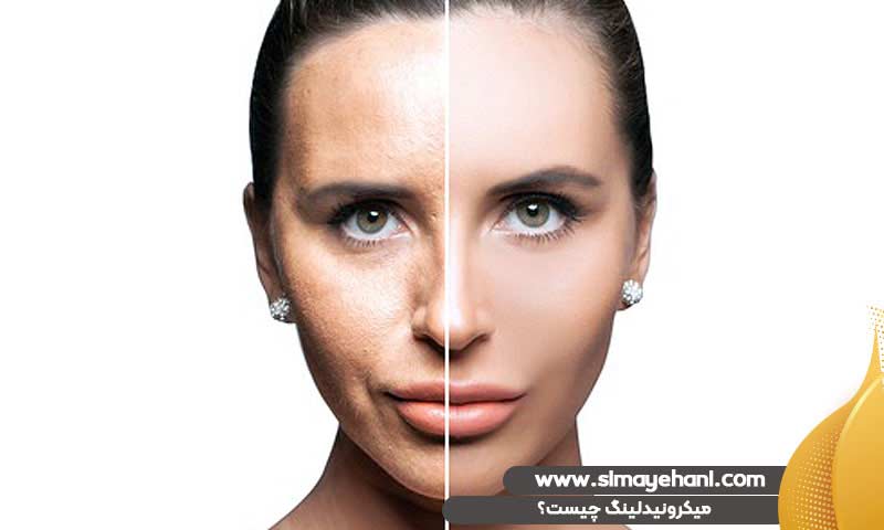 میکرونیدلینگ چیست