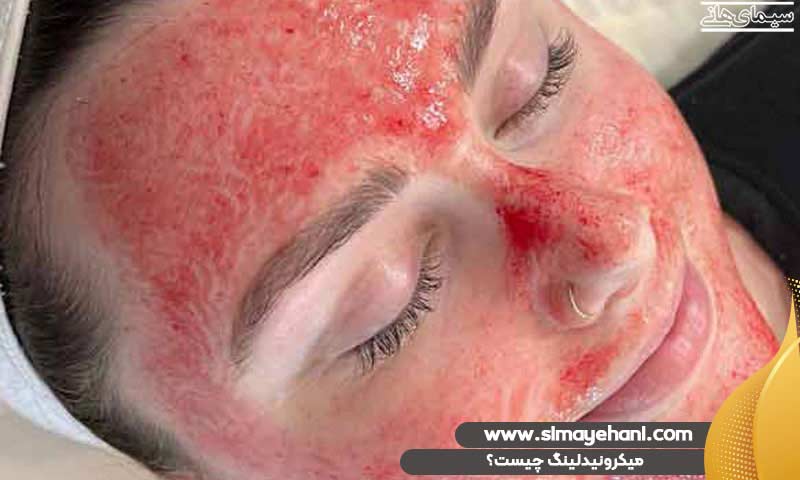 میکرونیدلینگ چیست